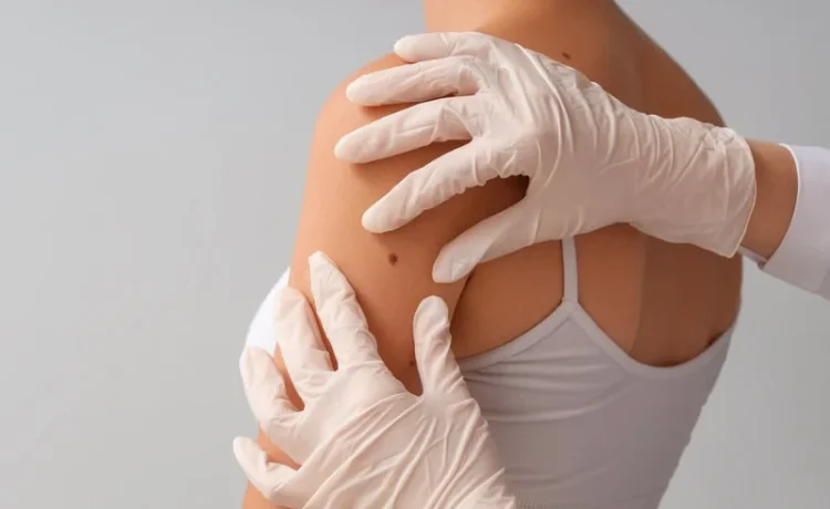 Moderna y Merck anuncian resultados positivos de una vacuna contra el cáncer de piel