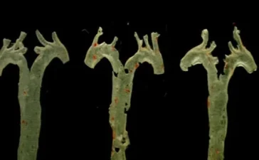 Ciencia revela que bacteria intestinal podría predecir la principal causa de muerte mundial