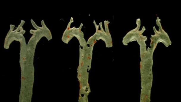 Ciencia revela que bacteria intestinal podría predecir la principal causa de muerte mundial