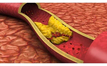 Aterosclerosis: la amenaza vascular que avanza con síntomas silenciosos en República Dominicana