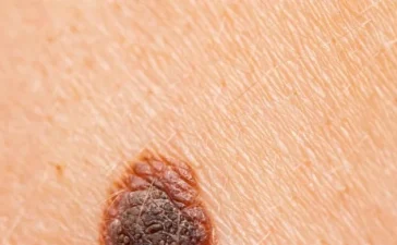 Hito en oncología: vacuna de ARN mensajero contra el melanoma reduce 42 % el riesgo de muerte