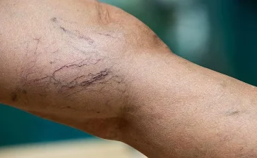 Varices: la advertencia médica sobre una enfermedad circulatoria que puede complicarse