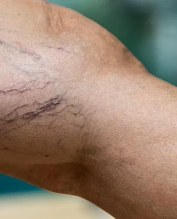 Varices: la advertencia médica sobre una enfermedad circulatoria que puede complicarse