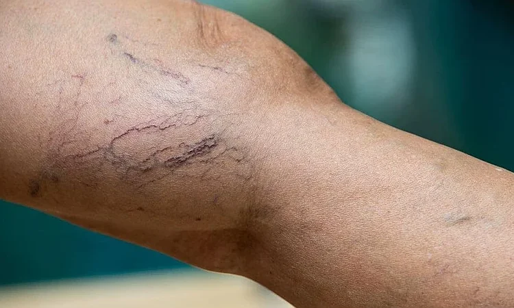 Varices: la advertencia médica sobre una enfermedad circulatoria que puede complicarse